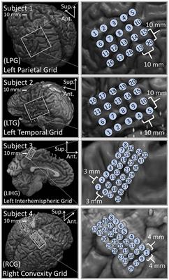 Artifact propagation in subdural cortical electrostimulation: Characterization and modeling